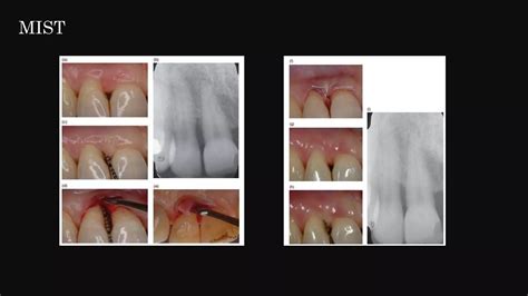 Minimally Invasive Periodontal Surgery Ppt