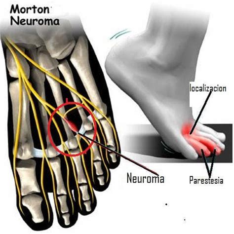 Diagnóstico del neuroma de Morton Cómo saber si lo padeces FisioOnline