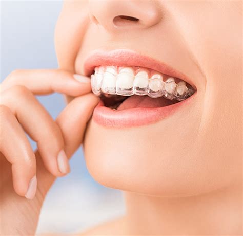 Invisalign IQ Braces And Faces