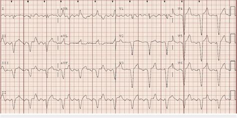 12 Lead Electrocardiogram Showing Atrial Flutter Waves With Ventricular