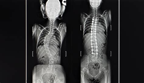 Adolescent Idiopathic Scoliosis Chibuikem Akamnonu Md