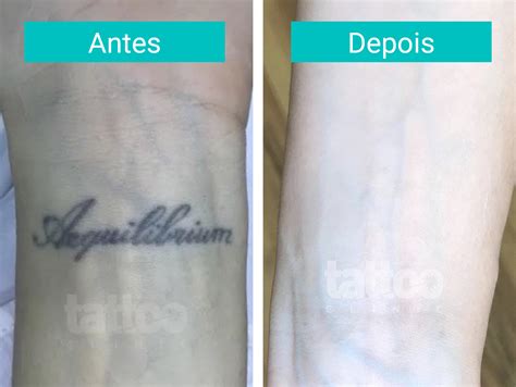 Remoção de Tatuagem a Laser Antes e Depois Tattoo Clinic