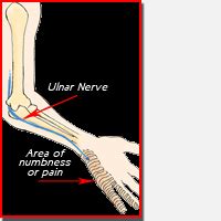 Neuritis: Ulnar Neuritis Surgery