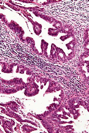 Adenocarcinoma Of The Uterine Cervix Libre Pathology