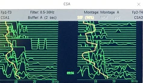 Compressed Spectral Array Csa Paediatric Emergencies