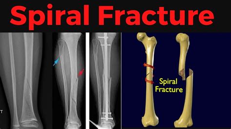 Spiral Fracture Tibia