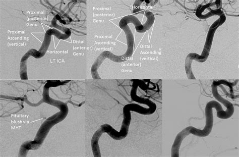 Internal Carotid Artery And Its Aneurysms Neuroangio Org