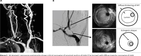 Figure 2 from Unilateral Pulsus Parvus et Tardus Waveform Discovered ...