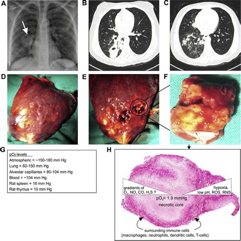 Typical Chest Radiograph Hrct And Granuloma Of A Tb Patient A Plain Download Scientific