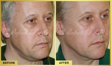 Perfect Body Laser And Aesthetics Non Surgical Face Neck Lift