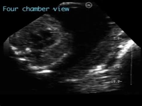 Atrioventricular Septal Defect AVSD Complete ULTRASOUNDPAEDIA