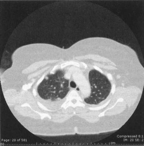 Spontaneous Hemothorax Chest