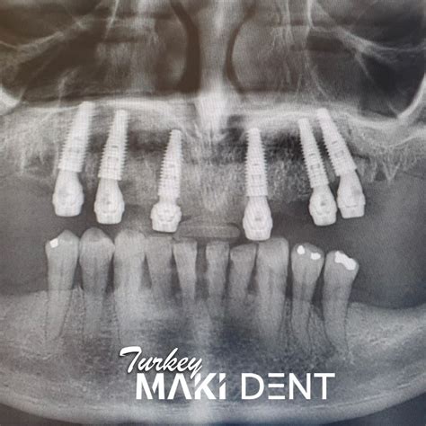 All On Dental Implants Turkey Cost Dental Clinic In Antalya