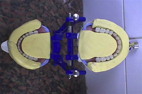 Setting Of Artificial Teeth Is Done According To The Neutral Zone Index