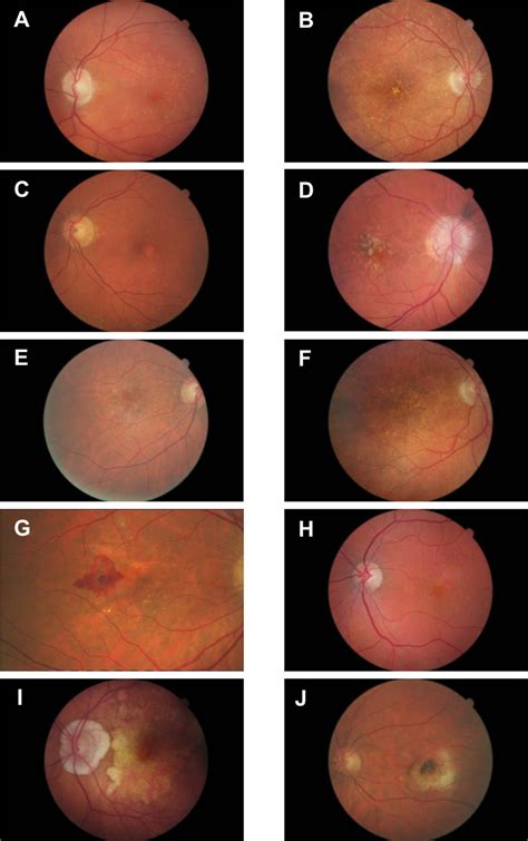 A Pigment Hyperplasia And Parafoveal Retinal Pigment Epithelium RPE