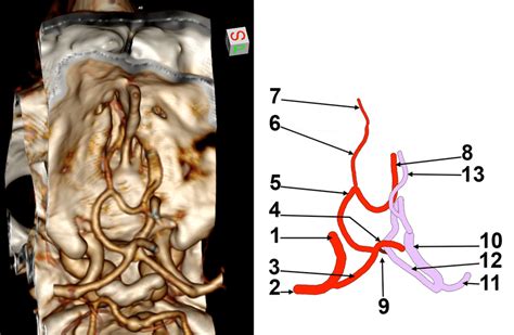 Left Persistent Primitive Olfactory Artery Ppoa Three Dimensional