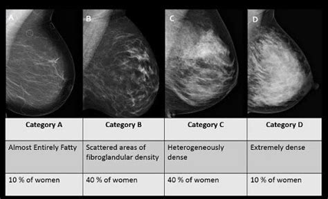 Information about dense breast tissue | Treatments | Patients & Families | UW Health