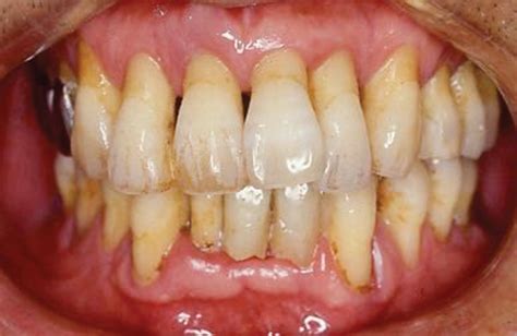 Treatment Of Advanced Periodontal Disease Keys To Achieving