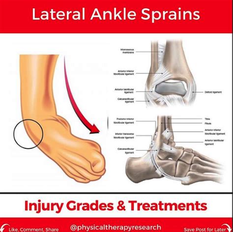 Lateral Ankle Sprains: Injury & Treatments - Evalyn Porter - Blog