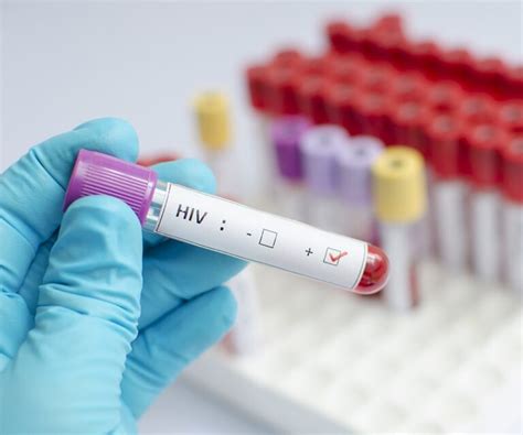 Qual O Exame Para Detectar Hiv