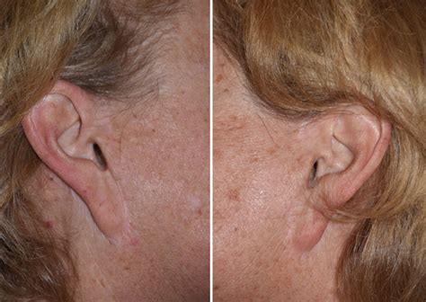 Plastic Surgery Case Report Correction Of Pixie Ear Deformity By Secondary Facelift Explore