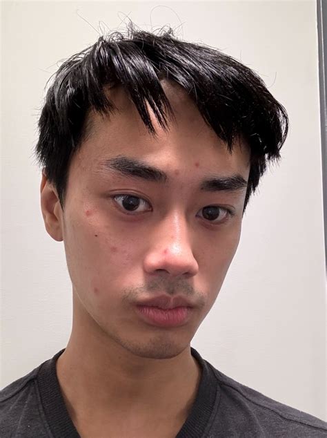 [Acne] Only getting acne on one side of my face? : r/SkincareAddiction