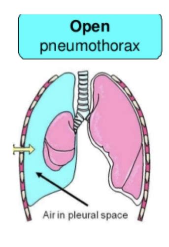 Patho Quiz Pulmonary Flashcards Quizlet