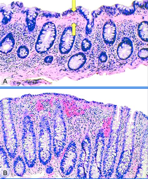 Histological features of microscopic colitis. (A) Collagenous colitis ...