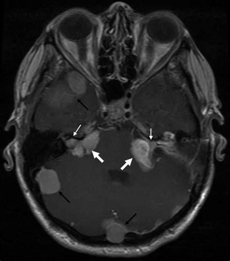 Neurocutaneous Syndrome » Department of Neurology » College of Medicine » University of Florida