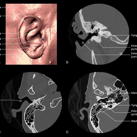 Middle Ear Anatomy Epitympanum Mesotympanum Hypotympanum Tegmen