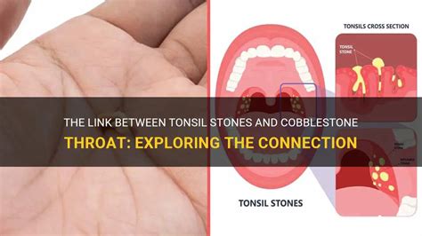 The Link Between Tonsil Stones And Cobblestone Throat: Exploring The ...