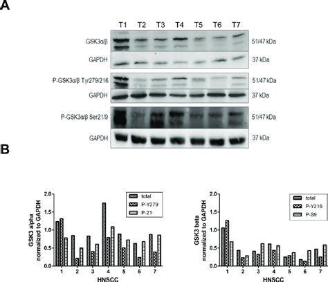 Gsk3αβ Expression Profiles In Solid Hnscc Western Hybridization