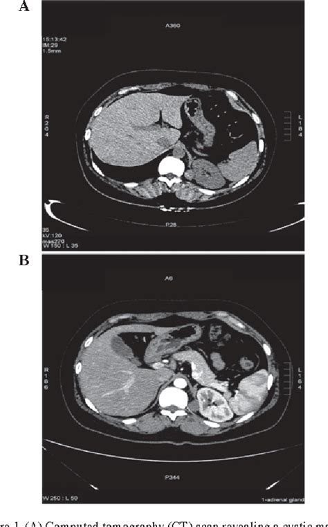 Figure From Diagnosis And Treatment Of Retroperitoneal Bronchogenic