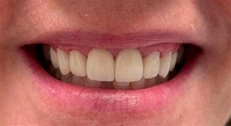 Tampa FL Dentist Before After Photos