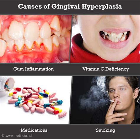 Gingival Hyperplasia Treatment