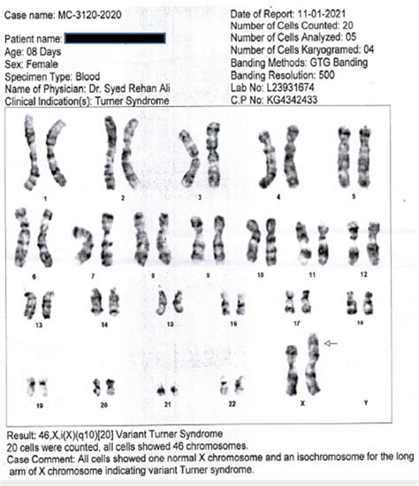 Cytogenetic Report Showing A Gene Karyotype Of 46xix Q10 20