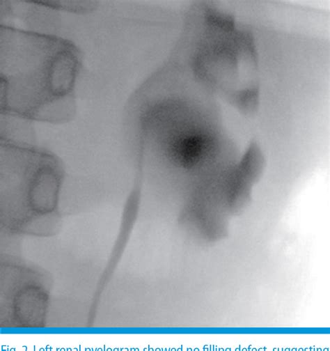 Figure 2 From A Case Of An Ureteropelvic Junction Obstruction Caused By A Crossing Vessel