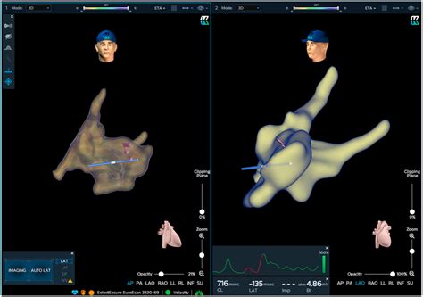 Anatomical Map With His Lead Using Kodex‐epd System Shows A Case Of Download Scientific