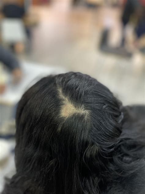 Bald spot for the first time (more in comments) : r/FemaleHairLoss