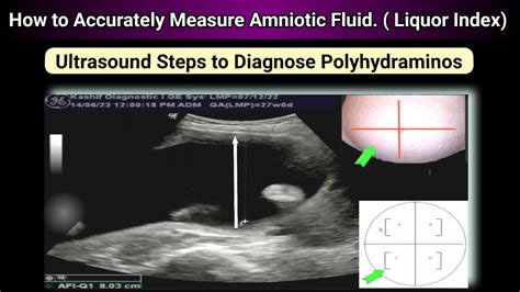 Ultrasound Pregnancy How To Measure Amniotic Fluid Accurately Fluid