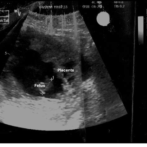 A Trans Vaginal Ultrasound Scan Showing The Placenta Implanted Low And Download Scientific