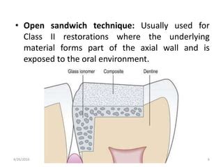 Sandwich Technique PPT