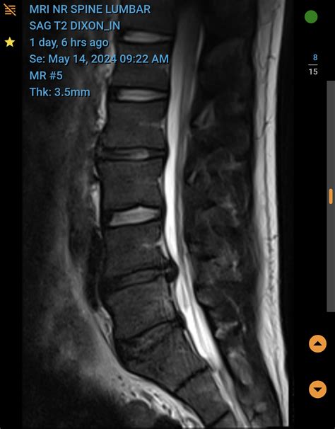 MRI lower back : r/medical