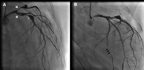 Fibromuscular Dysplasia Presented With Spontaneous Dissection Of The