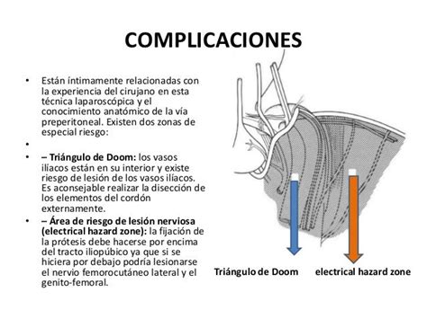 Laparoscopica Hernia Inguinal Ppt