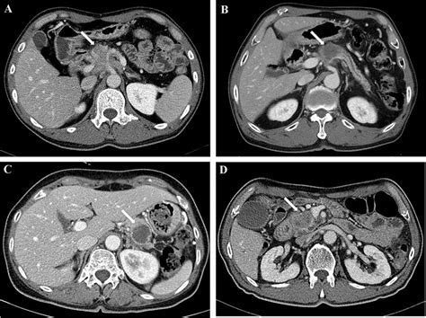 Representative Cases Of Four Enhancement Patterns Of Pancreatic Ductal