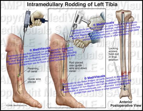 Intramedullary Rod Tibia