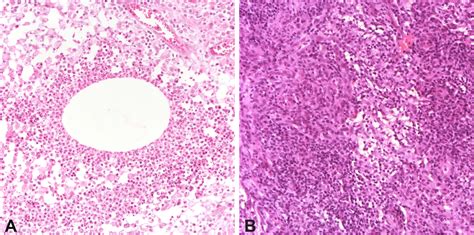 Idiopathic Granulomatous Mastitis And Cystic Neutrophilic Granulomatous