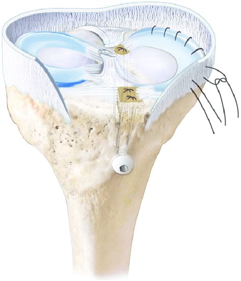 Appearance Of The Final Anterior And Posterior Tunnel Fixation Of A