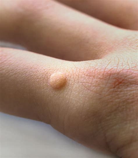 Warts Med Spa In Tulsa Ok Tulsa Hills Cosmetic And Laser Skin Center